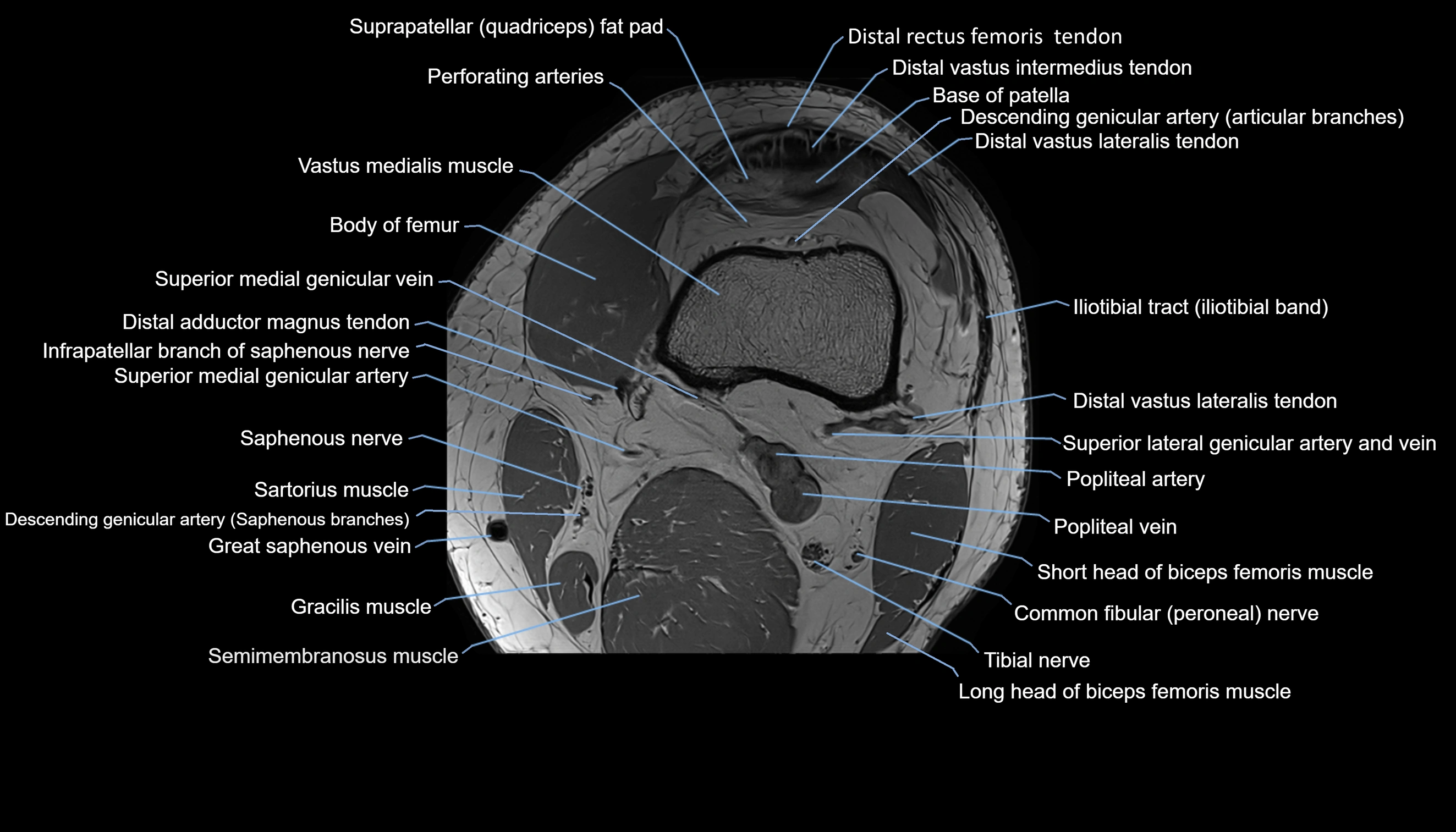 MRI knee  axial cross sectional anatomy 3T radiology  image-img-00001-00007.webp